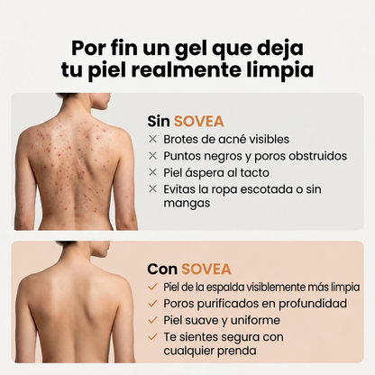 Gel De Baño Anti Acné SOVEA™